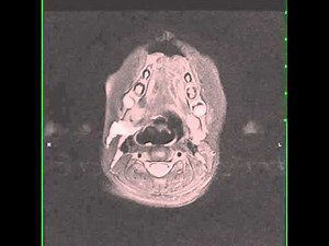 Second Branchial Cleft Cyst with Rupture