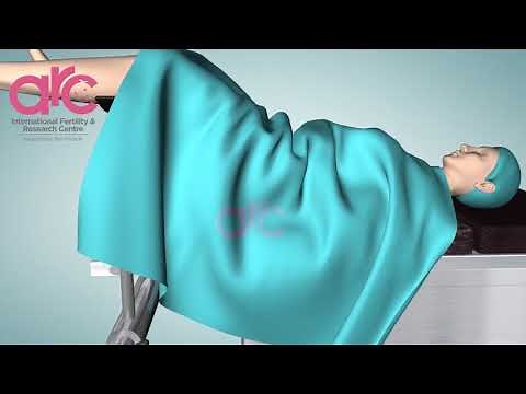 ICSI 3D video - Intra Cytoplasmic Sperm Injection - Steps , Process.ARC Fertility Hospitals