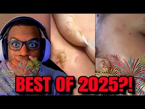 2025 Craziest Pimple Popping Videos Compilation