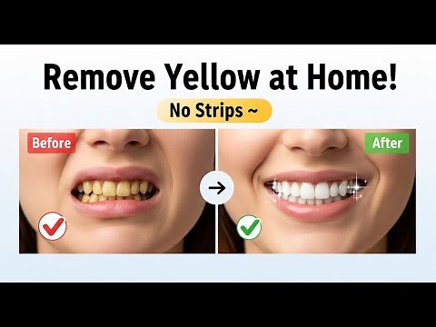 Remove Yellow Stains from Teeth at Home – Whiten Naturally (No Strips)