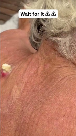 Large Blackheads Extraction Big Cystic Acne Blackheads&Whiteheads Removal Pimple Popping #1018 2026