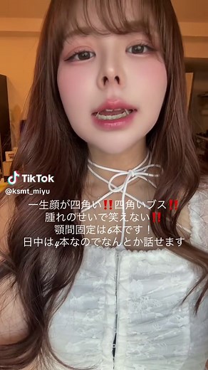 顎変形症とルフォーSSRO手術の詳細