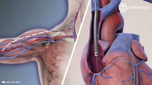 23K views · 425 reactions | Fully Subcutaneous AV Access Solution to Maintain Long Term Access for Hemodialysis Patients with Central Venous Stenosis | SurgMedia | Facebook