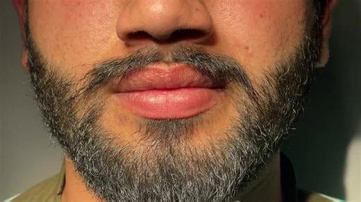 Lip Reduction Surgery: Transforming Your Smile