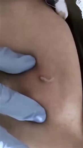 pimples on faces #cravos #blackhead #zit #popper #acne #zits #pimplepop #pimple #popping #asmr #pimples #fyp #live