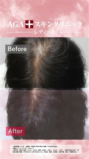 女性の薄毛治療でここまで変化💡