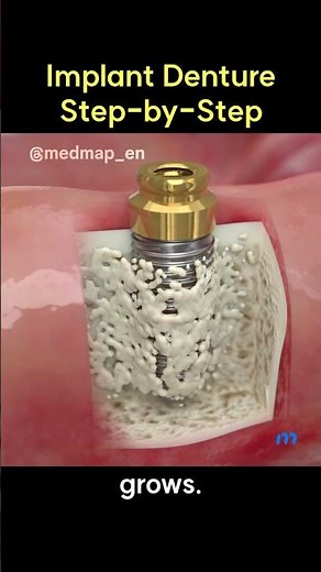 Implant Denture Step-by-Step