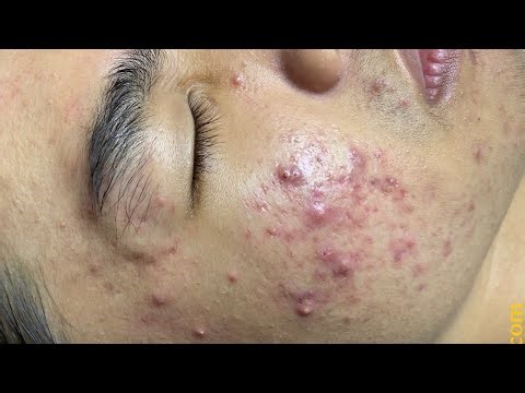 Pimple Popping & Acne Removal | Deep Extraction Treatment