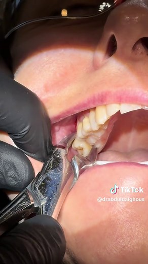 Upper Wisdom Tooth Extraction Guide