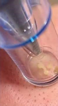Blackhead Remover Vacuum: Deep Pore Cleansing for Clear Skin (Tutorial & Demo)