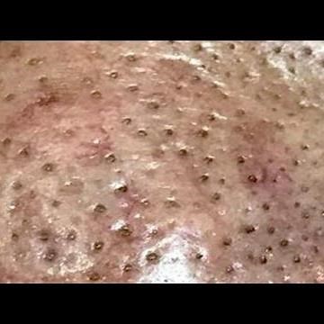 SATISFYING BLACKHEAD REMOVAL 2020