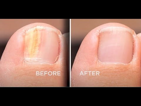 CRYSTAL FLUSH - TOENAIL FUNGUS SYSTEM Crystal Flush Official Video