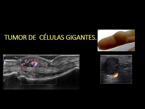 Tumor de Células gigantes de la vaina sinovial/ Giant cell tumor of tendon sheath