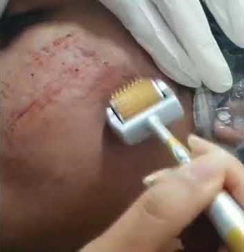 What Derma-roller does to skin?