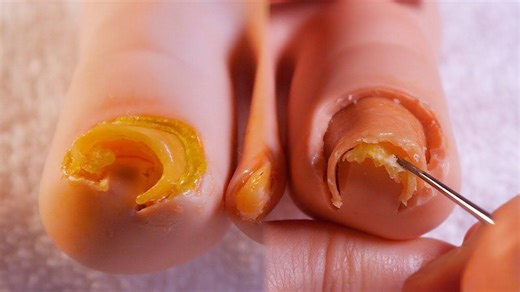 『rappeler』中文 8.23 嵌入肉中的内生趾甲，双脚护理   去角质，保湿护理