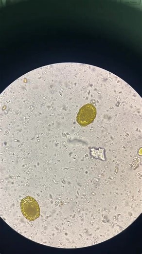 23K views · 421 reactions | Stool sample  #lablife #microbiology #MedicalLabTechnician | Lab life | Facebook