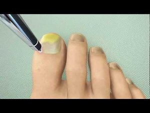 PinPointe FootLaser for the Treatment of Toe Nail Fungus