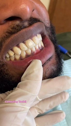 Enhance Your Smile with Teeth Contouring | Cosmetic Dentist Tips