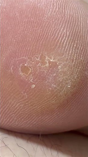 ウイルス性イボ 踵 液体窒素 治療 (2025.10.05) / Viral Wart Heel Treatment with Liquid Nitrogen (2025.10.05)