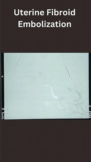 Uterine Fibroid Embolization