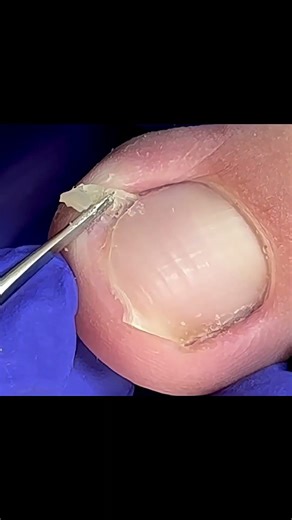 Satisfying pedicure video! #pedicure #toenails #satisfying #nails