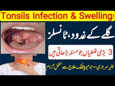 Tonsillitis Treatment: How to Cure Tonsils Permanently No Surgery | Best Homeopathic Medicine
