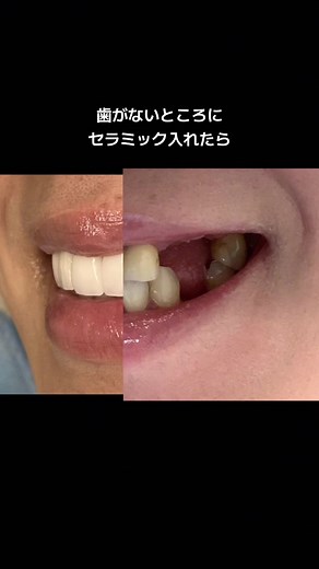 歯がないところにセラミック入れたら・・・#セラミック #セラミック矯正 #差し歯 #歯並び #前歯 #歯 #千葉駅