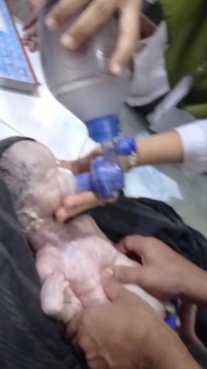 New born baby resuscitation #hospital #CPR | Medical practice