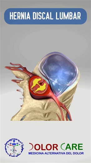 🚨🚨 Sabias que a tiempo puedes evitar una CIRUGIA por HERNIA DISCAL 🚨🚨 ‼️AGENDE SU CITA para valoración y en Dolor Care te explicamos todo sobre la hernia discal y los tratamientos NO Quirúrgicos que existen ‼️😊 No dejes que el dolor te impida vivir 😊 Te ofrecemos una atención integral y de calidad 😊 El testimonio de nuestros pacientes nos avala positivamente 👨🏽‍⚕️ Agende su cita de valoración con el médico especialista 👇🏼 📲 442 778 6620 📍Av. Chabacano 133, Risco Residencial, 76903 V