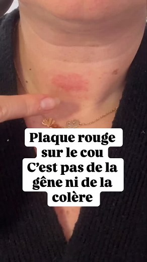 19K views · 122 reactions | Les plaques rouges sur ton cou, ce n’est...