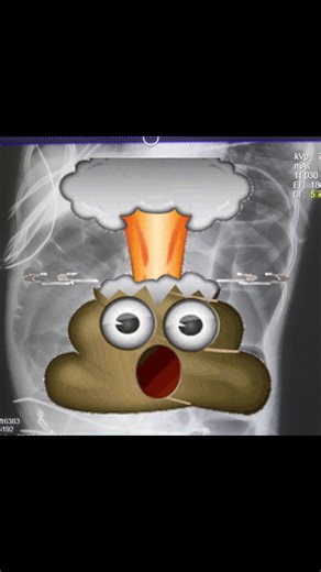 Ogilvie’s syndrome or acute colonic pseudo-obstruction is a syndrome that causes marked abdominal distension without evidence of mechanical obstruction. #olgiviesyndrome —>This is an emergency and can lead to an exploding colon —>Treated initially by emergent decompression #colonoscopy —>Usually happens is very sick patients usually in the ICU for other issues. —>This patient did great! #Gastroenterologist #GI #Doctor #Gidoctor #Gastroenterology #Healthcare #Coloncancer #Coloncancerscreening #Sc