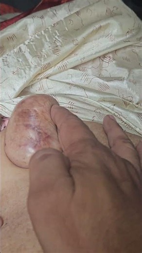Umbilical Hernia #imwell