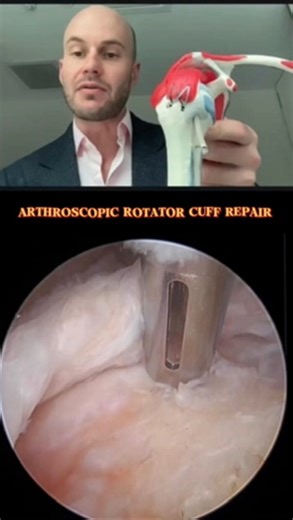 Dr Joe Coory on Instagram: "Arthroscopic Rotator Cuff Repair • PART THREE In this video, I talk through completing the construct and finalising the repair. 🪡🦾 #orthopaedicsurgery #rotatorcuffrepair #arthroscopicsurgery #medicaleducation #surgeryexplained"