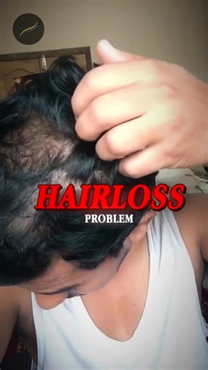 5 Signs to Detect Androgenetic Alopecia Hair Loss - Don’t Ignore These Warnings!