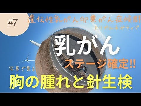 #7 乳がんステージ確定‼️写真で見る胸の変化と針生検