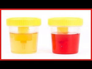 尿に血が混じる！血尿の症状とその原因