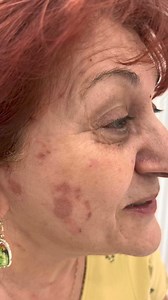 טיפול קנסטלזמה – שיפור מיידי לעור ללא צלקות! ✨👨‍⚕️👩‍⚕️ גברים ונשים, זה הזמן להרגיש שוב נוח בעור שלכם!🌟 תוצאות מדהימות עם לקוחות מרוצים!📍 בואו לבקר אותנו באשקלון – נשים וגברים מכל הארץ🥰#קנסטלזמה#טיפולבעור#שיקוםעור#יופיונשים#יופיגברים#עורבריא#קליניקהבאשקלון#טיפוליםקוסמטיים#טיפולבפנים#פייסבוקי#אינסטגרםישראל#תוצאותמרשימות#לקוחמרוצה#דואגיםלעור#יופיולב | יערה - קוסמטיקאית רפואית