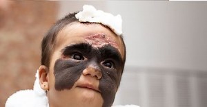 This toddler born with a ‘Batman mask’ birthmark is internet’s favourite superhero