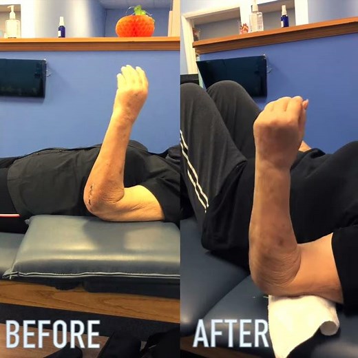 Left Elbow Fracture - Progress