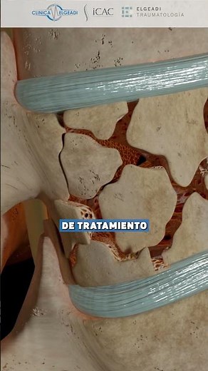 Fracturas traumáticas de la columna
