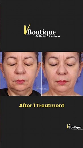 VBoutique - Dr V - Before and After 1 Session of XERF!