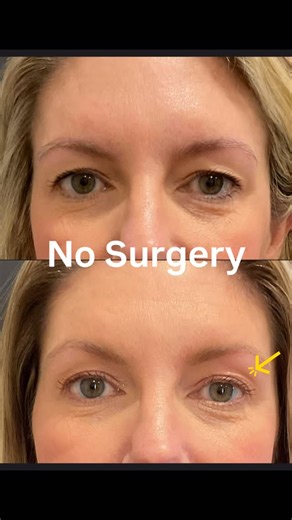 Atlanta Dermatology | Misty Med Spa & Skin Rx on Instagram: "Meet Sofwave Eyes — the non-surgical eye lift that tightens, smooths, and refreshes the delicate eye area using advanced ultrasound technology. At Misty Med Spa, Sofwave Eyes targets fine lines, laxity, and under-eye crepiness by stimulating your skin’s own collagen production — no needles, no downtime, and no overdone look. ✨ Lifts brows & upper lids ✨ Smooths fine lines & crepey skin ✨ Firms under-eye laxity ✨ Natural results that im