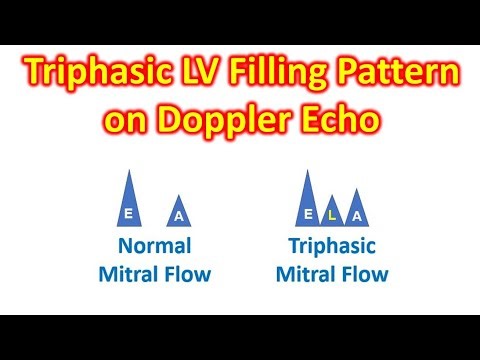 Triphasic LV Filling Pattern on Doppler Echo