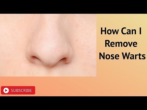 How Can I Remove Nose Warts