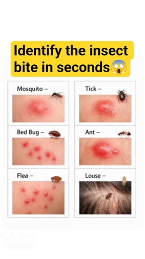🚨 6 Common Insect Bites on Human Skin#insects #healthawareness