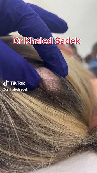 Large Pilar Cyst Removal by Dr Khaled Sadek