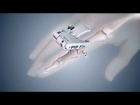PIP Fix Surgical Technique Video