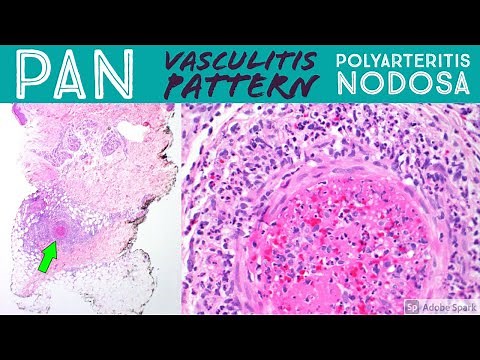 Polyarteritis nodosa & leukocytoclastic vasculitis pattern: Inflammatory Dermpath Basics