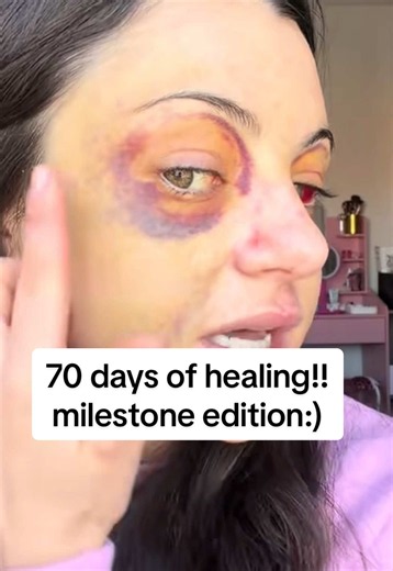It’s officially been 70 days since my attack which marks the transition from from acute recovery to chronic recovery…meaning I medically won’t need intervention or medication for it anymore and can focus treatment on emotional and cognitive symptoms (like my amnesia) I am so proud of myself :) #tbi #attack #healing #fracture #healingjourney