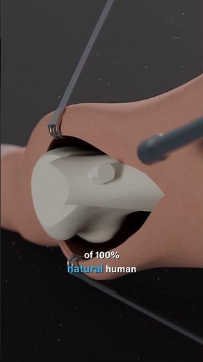 This bunion correction uses a 100% natural bone screw